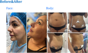 980nm 1470nm Diode Laser endolifting Máy lipolysis | chai chanh tiêm | sculptra BBL mông phụ | GLP-1 giảm béo - Product Image 2