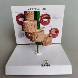 4 buah Model demonstrasi trombus arteri manusia sains medis Model penyakit manusia - Product Image 3