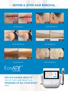 Máquina de Depilación Láser de Diodo Portátil de Alta <span class=keywords><strong>Calidad</strong></span> a <span class=keywords><strong>Precio</strong></span> de Fábrica con Certificación Médica CE - Product Image 4