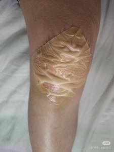 Hidrokolloid yara pansuman Bedsore teşvik yara şifa hidrokolloid tıbbi bant ölçeklenebilir çevre dostu hidrokolloid - Product Image 3