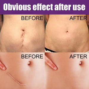 South <span class=keywords><strong>Moon</strong></span> Parche de silicona Cicatrices Cicatriz Hojas de gel Hoja de eliminación de cicatrices de silicona con tamaño 7,5*4cm - Product Image 3