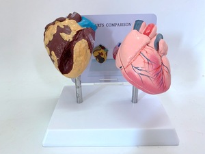 Modelo <span class=keywords><strong>de</strong></span> Anatomía <span class=keywords><strong>de</strong></span> Órganos Humanos para Comparar Corazones Patológicos y Sanos, <span class=keywords><strong>de</strong></span> Plástico, para Educación Médica, Yulin YL2-30079 - Product Image 4