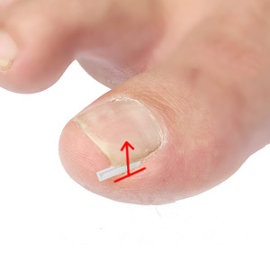 10 pièces/boîte C forme <span class=keywords><strong>ongle</strong></span> <span class=keywords><strong>incarné</strong></span> Correction Liner pédicure outil traitement des ongles accepter la personnalisation - Product Image 3