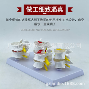 Modelo patológico de columna lumbar de cuatro etapas; modelo esquelético patológico; esqueleto deformado; modelo de columna vertebral patológica. - Product Image 3