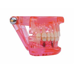 Modelo de Implante Dental, Modelo de Práctica de Restauración Dental - Product Image 4