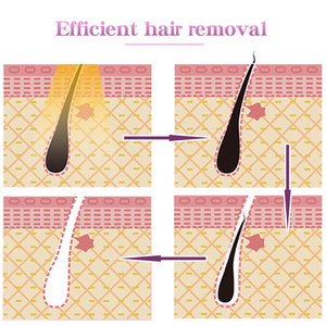 Professional Hair Removal <b>Machine</b> 755nm/808nm/1064nm 3 Wavelength Diode Laser Medical Beauty <b>Machine</b> - Product Image 4