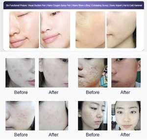 Máquina Facial de Oxígeno Hidroeléctrico de Escritorio con 6 Manijas, Pantalla de 10 Pulgadas, Limpieza Profunda, Equipo de Belleza Antienvejecimiento - Product Image 5