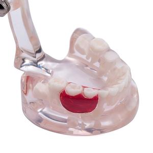 Gelsonlab HSDT-C8 Mixte Clair avec dents manquantes modèle de Dents Dentaires Pathologie Modèle D'étude Démonstration Modèle D'enseignement - Product Image 6