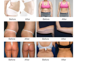 Chuyên nghiệp <span class=keywords><strong>V8</strong></span> 2in1 cơ thể loại bỏ chất béo đốt thắt chặt máy định hình Cellulite giảm bóng bên trong con lăn Máy giảm béo - Product Image 6