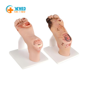 Modelo de pie diabético (leve/severo) para formación médica, educación y prevención, maniquí de pie diabético. - Product Image 1