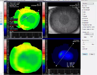 Peta Analisis Kornea Lengkungan Permukaan dari Corneal Lab Mata Optometri Mata Optometri Topographer Kornea