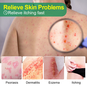 Crema ZB per Psoriasi, Dermatite ed Eczema, Unguento Erboristico Antibatterico Anti-Prurito per Eczema Cutaneo - Product Image 2