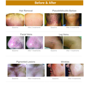 Mesin <span class=keywords><strong>Laser</strong></span> penghilang rambut, 1064nm, <span class=keywords><strong>Laser</strong></span> depilasi, dioda pencukuran <span class=keywords><strong>Laser</strong></span> Lazer Alexander Alex 755nm, mesin penghilang rambut Alexandrite - Product Image 6