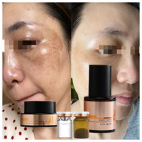 Best-seller - Ensemble de soin pour éliminer les taches noires et les taches brunes - Correcteur de teint - Traitement du mélasma - Gommage chimique pour le visage - Kits professionnels 3 en 1