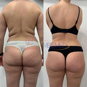 Système professionnel d'élimination de la graisse par laser froid 10D, machine de remodelage corporel non thermique, élimination de la graisse par laser émeraude - Product Image 6