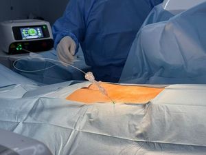 Laser do diodo 980nm 1470nm PLDD para a descompressão minimamente invasiva do disco - Product Image 6