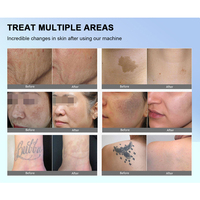 Máquina de Eliminación de Tatuajes con Láser Nd Yag de Picosegundos con Certificación CE, Peeling de Carbón para Cuidado de la Belleza, Garantía Comercial de 5 Años