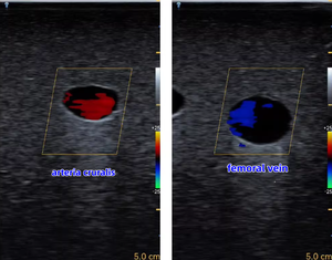 Simulador de Entrenamiento ECMO - Modelo de Entrenamiento para Punción Arterio-Venosa Femoral Guiada por Ultrasonido - Product Image 4
