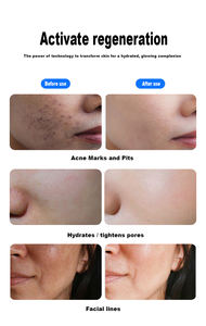 Appareil de beauté faciale non invasif sans douleur sans aiguille pistolet à eau haute pression pistolet de mésothérapie à eau Machine de beauté faciale - Product Image 3