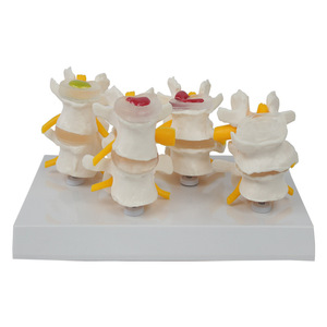 Modèle comparatif de colonne vertébrale lombaire pathologique à 4 étapes ; modèle de squelette humain, modèle pédagogique, fournitures du fabricant. - Product Image 4