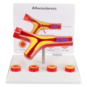 Modelo Anatómico de <span class=keywords><strong>Arteriosclerosis</strong></span> de 4 Partes con Sección Transversal de Arteria, Modelo de Ciencia Médica para Enseñanza Médica a Pacientes y Doctores - Product Image 1
