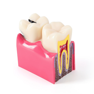 Azdent modello di insegnamento dentale 6 volte carie due lato contrasto anatomico per l'educazione del paziente e spiegazione - Product Image 1