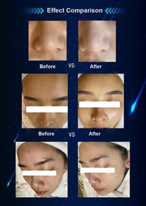 Máquina Profesional de Limpieza Facial para el Cuidado de la Piel, 11 en 1, Reafirmante, con Microdermoabrasión y Burbujas Pequeñas - Product Image 3
