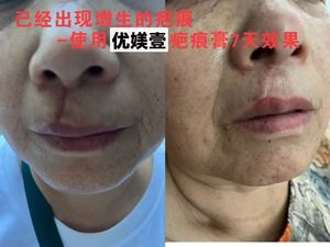 Crema Reparadora de Cicatrices con Fórmula Personalizada de Vidrio Bioactivo, Tratamiento para Marcas de Estrías del Embarazo, 20g, Cicatrices de Cesárea - Product Image 5