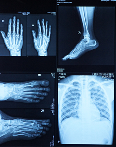 Film radiographique thermique sec médical <span class=keywords><strong>Agfa</strong></span> DT2B/5B/10B, base bleue 14*17, pour Drystar 5302/5503, pour l'imagerie hospitalière CR/DR/CT/MRI - Product Image 5