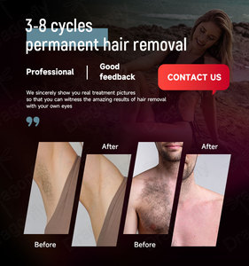 Tẩy lông bằng laser alexandrite Công suất cao | công nghệ xung dài để làm rụng lông hiệu quả | Phích cắm EU phổ quát cấp thương mại - Product Image 3