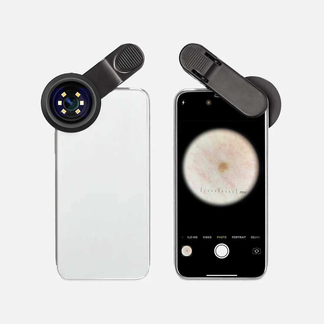 IBOOLO DE-300 Advance Professional Surgical Smartphone Dermatoscope、皮膚診断ダーマスコープセット皮膚器具