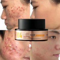 Crème OEM naturelle à l'acide salicylique pour resserrer les pores, contrôler l'acné et l'excès de sébum, avec extrait d'hamamélis – Meilleure crème anti-acné pour le visage et l'élimination des boutons