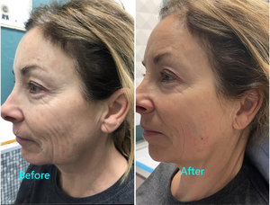 Liposuccion Endo Laser Lifting du visage <span class=keywords><strong>Double</strong></span> <span class=keywords><strong>menton</strong></span> Suppression des poches sous les yeux <span class=keywords><strong>Injection</strong></span> de fibres minceur 980nm 1470nm <span class=keywords><strong>Lipolyse</strong></span> Machine de perte de poids - Product Image 4