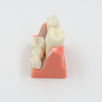 Modèle d'implant dentaire Éducation du patient Modèle dentaire Anatomie des dents Implant Couronne Pont Modèle de formation dentaire