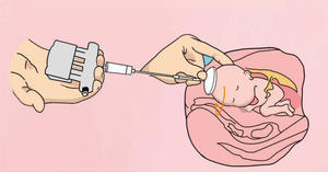 Forniture chirurgiche di <span class=keywords><strong>ostetricia</strong></span> e <span class=keywords><strong>ginecologia</strong></span> attrattore testa-up monouso - Product Image 4