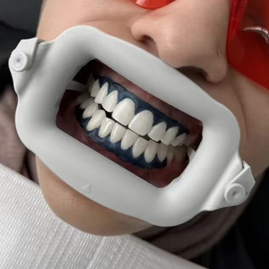 Divaricatore Dentale in TPR per Ortodonzia e Sbiancamento dei Denti, Modello SD-B-W01 per Uso Commerciale Conveniente - Product Image 1