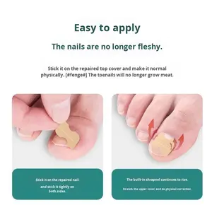 เครื่องมือแก้ไขรูปแบบ G3D11แบบไร้กาวขอบสำหรับเล็บเท้าแผ่นตัดเล็บเนื้อคุดแบบไม่มีร่อง - Product Image 4