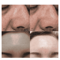 Máquina de Hidrofacial con Doble Mango y Infusión Vortex, Hidradermoabrasión Giratoria de 360° para Limpieza Facial, Peeling y Tonificación