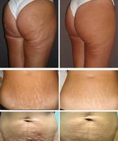 Machine portative intelligente de thérapie de CO2 Carboxy pour le lifting dissolvant de rides cernes réduction de la cellulite Combo CO2 Carboxy