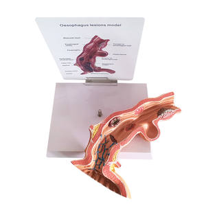 Modelo Anatómico de Enfermedad Patológica del Esófago KyrenMed, Modelo de Polipo Esofágico con <span class=keywords><strong>Erosión</strong></span>, Ampliado 5 Veces - Product Image 4