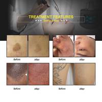 Appareil de rajeunissement facial au laser, d'élimination des tatouages, NdYag Q-Switched Picoseconde, laser stationnaire, usage commercial, 2 ans