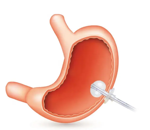 Kits de <span class=keywords><strong>gastrostomie</strong></span> <span class=keywords><strong>endoscopique</strong></span> <span class=keywords><strong>percutanée</strong></span> (PEG) 20F 22F 24F avec tubes PEG jetables de type luxe en plastique pour l'endoscopie - Product Image 5