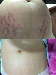 Elimine las cicatrices quirúrgicas de quemaduras y escaldaduras Láser fraccional de piel de CO2 al por mayor con mango de ajuste vaginal - Product Image 2