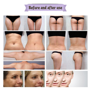 S Hình Dạng Chất Béo Burner Máy 6 Trong 1 Trọng Lượng Giảm Cân Chất Béo Loại Bỏ Massager Cellulite Máy Loại Bỏ Chân Không Cavit 80K Cavit Máy - Product Image 4