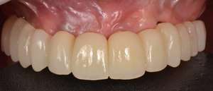 Denti Artificiali <span class=keywords><strong>in</strong></span> Resina Personalizzati con Alimentazione Elettrica per Tutti dai Laboratori Dentali Cinesi - Product Image 3