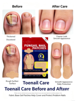 Patchs de réparation antifongiques pour ongles de nuit avec renouvellement et correction, marque privée