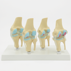 Modelo de Articulación de Rodilla, 4 Etapas de Lesiones: Normales, Ligeras, Moderadas y Severas, Patología de Osteoartritis, para Enseñanza Médica - Product Image 2