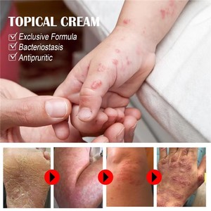 Crema Antinfiammatoria all'Ingrosso per Eczema Diodrotoico, Crema per il Corpo per Adulti, Mani e Piedi, Vesciche e Pelle Irritata, Etichetta Personalizzata, Confezione Personalizzata - Product Image 6