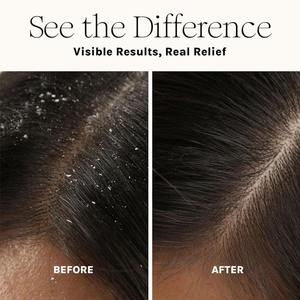 Nouveautés Soins capillaires : Traitements du cuir chevelu pour les démangeaisons et la sensibilité, <span class=keywords><strong>Masque</strong></span> détoxifiant pour le cuir chevelu, Dissolvant de dépôts capillaires pour le traitement des pellicules - Product Image 2