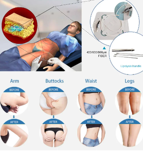 Sistema Láser de Diodo de Doble Longitud de Onda 980nm, Antienvejecimiento, Lipólisis, Eliminación <span class=keywords><strong>Vascular</strong></span>, Tratamiento de <span class=keywords><strong>Ojeras</strong></span> y Acné, Láser Portátil - Product Image 3
